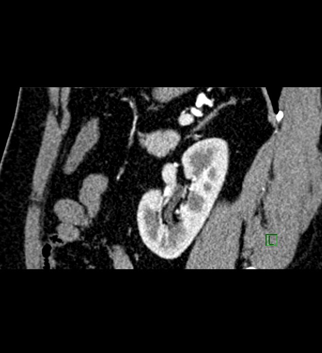 Chromophobe renal cell carcinoma (Radiopaedia 84286-99573 F 50).jpg