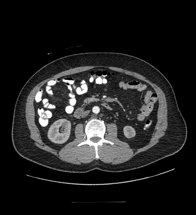 Chromophobe renal cell carcinoma (Radiopaedia 84337-99644 B 51).jpg