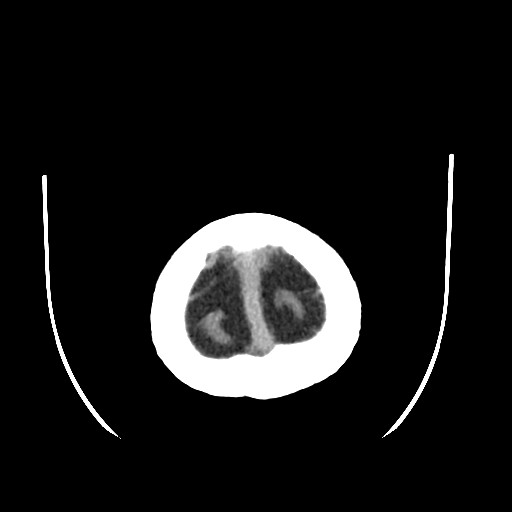 Chronic bilateral subdural hygroma (Radiopaedia 85801-101622 Axial non-contrast 67).jpg