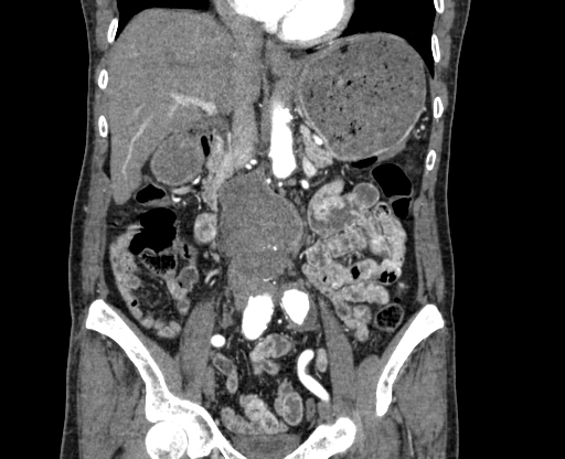 Chronic contained rupture of abdominal aortic aneurysm with extensive erosion of the vertebral bodies (Radiopaedia 55450-61901 D 32).jpg