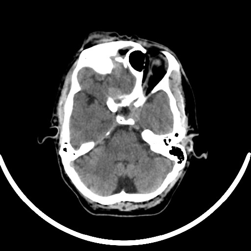 Chronic invasive fungal sinusitis with intraorbital and intracranial extension (Radiopaedia 56387-63046 Axial non-contrast 140).jpg