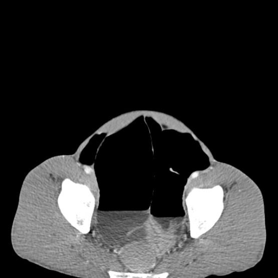 File:Chronic large bowel pseudo-obstruction (Radiopaedia 43181-46492 A 147).jpg