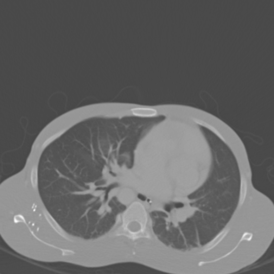 File:Chronic large bowel pseudo-obstruction (Radiopaedia 43181-46492 Axial bone window 12).jpg
