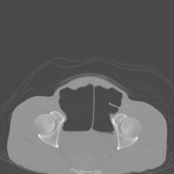 Chronic large bowel pseudo-obstruction (Radiopaedia 43181-46492 Axial bone window 152).jpg