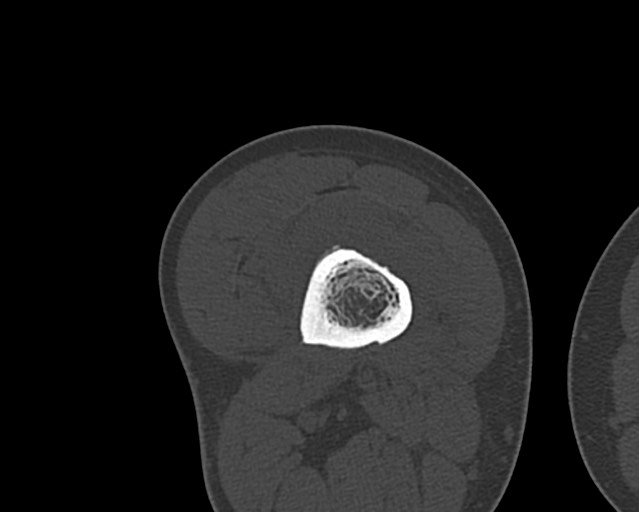 Chronic ostemyelitis of the femur with long sinus tract (Radiopaedia 74947-85982 Axial bone window 137).jpg