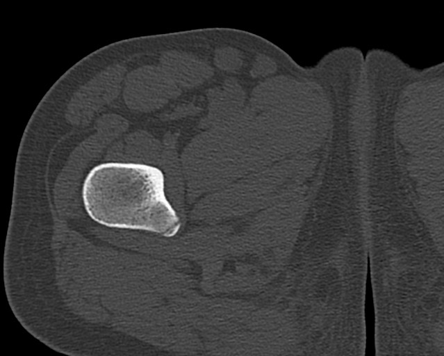 File:Chronic ostemyelitis of the femur with long sinus tract (Radiopaedia 74947-85982 Axial bone window 24).jpg