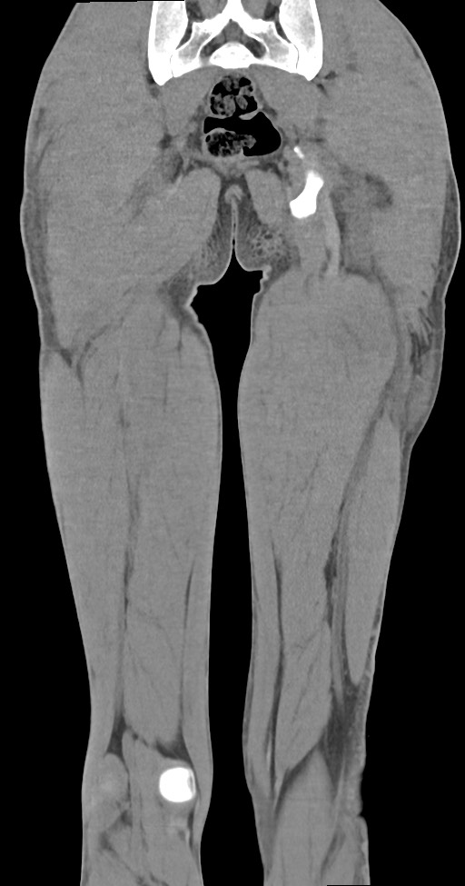 Chronic osteomyelitis (with sequestrum) (Radiopaedia 74813-85822 E 44).jpg