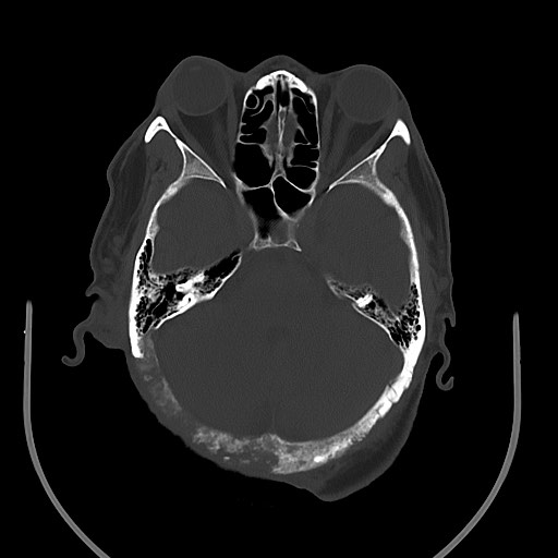 File:Chronic osteomyelitis - calvarial (severe) (Radiopaedia 69668-79616 Axial 1).jpg