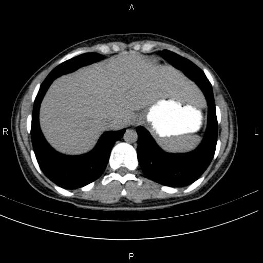 File:Chronic pancreatitis (Radiopaedia 64576-73450 Axial non-contrast 10).jpg