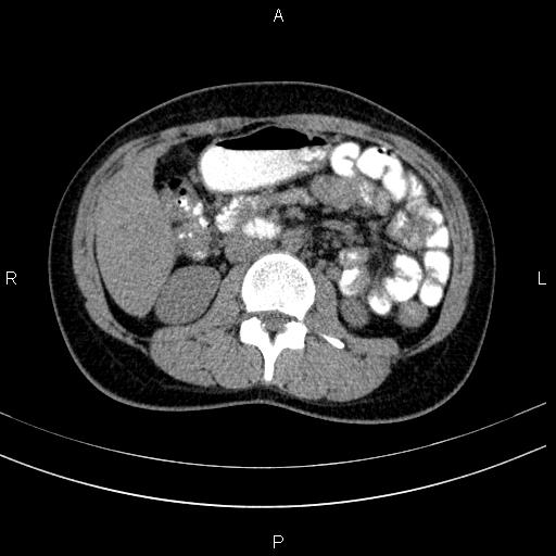 Chronic pancreatitis (Radiopaedia 64576-73450 Axial non-contrast 73).jpg