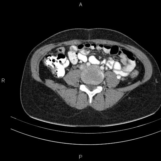 Chronic pancreatitis (Radiopaedia 64576-73450 B 104).jpg