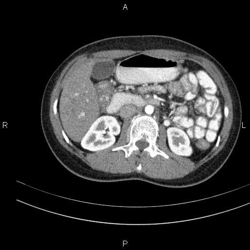 Chronic pancreatitis (Radiopaedia 64576-73450 B 66).jpg