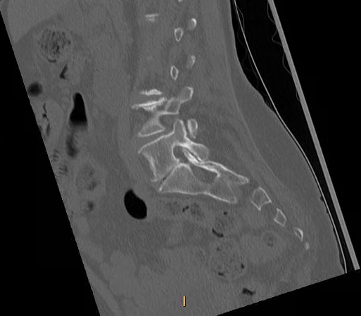 File:Chronic spinal hematoma with cauda equina syndrome (Radiopaedia 75745-88197 Sagittal bone window 9).png