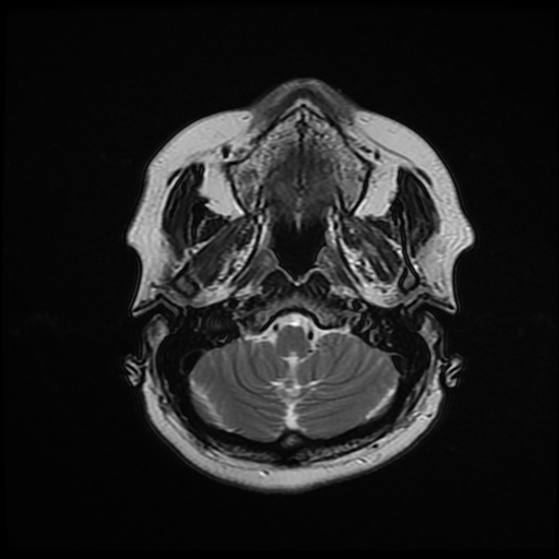 File:Chronic submandibular sialadenitis (Radiopaedia 61852-69885 Axial T2 4).jpg