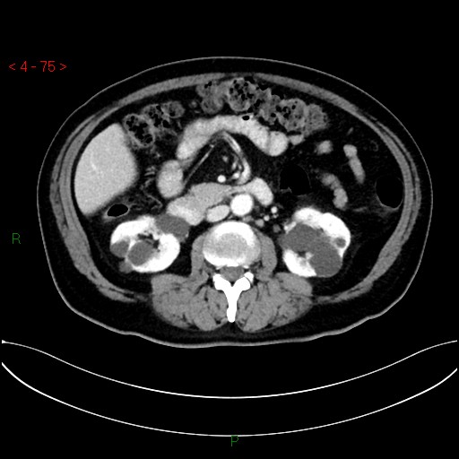 File:Circumaortic left renal vein and doubled left renal arteries (Radiopaedia 52268-58158 B 35).jpg