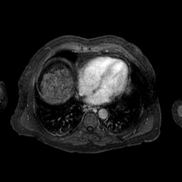 Cirrhosis and hepatocellular carcinoma in the setting of hemochromatosis (Radiopaedia 75394-86594 Axial T1 C+ fat sat 250).jpg
