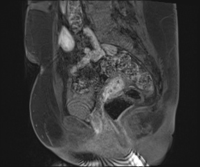 File:Class II Mullerian duct anomaly- unicornuate uterus with rudimentary horn and non-communicating cavity (Radiopaedia 39441-41755 G 53).jpg