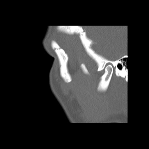 Cleft hard palate and alveolus (Radiopaedia 63180-71710 Sagittal bone window 9).jpg