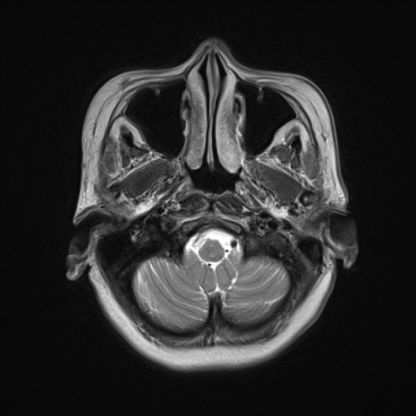 File:Clival meningioma (Radiopaedia 53278-59248 Axial T2 2).jpg