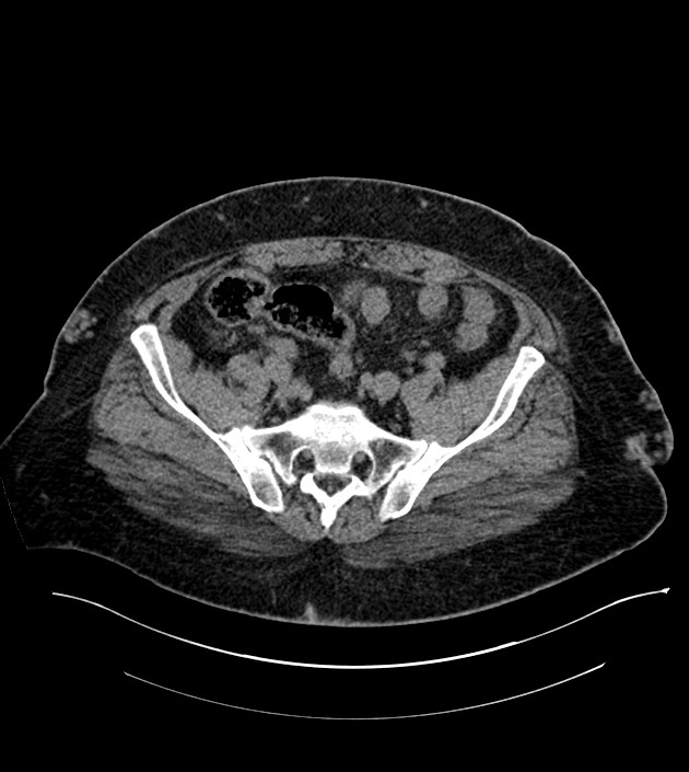Closed-loop small bowel obstruction-internal hernia (Radiopaedia 78439-91096 Axial non-contrast 120).jpg