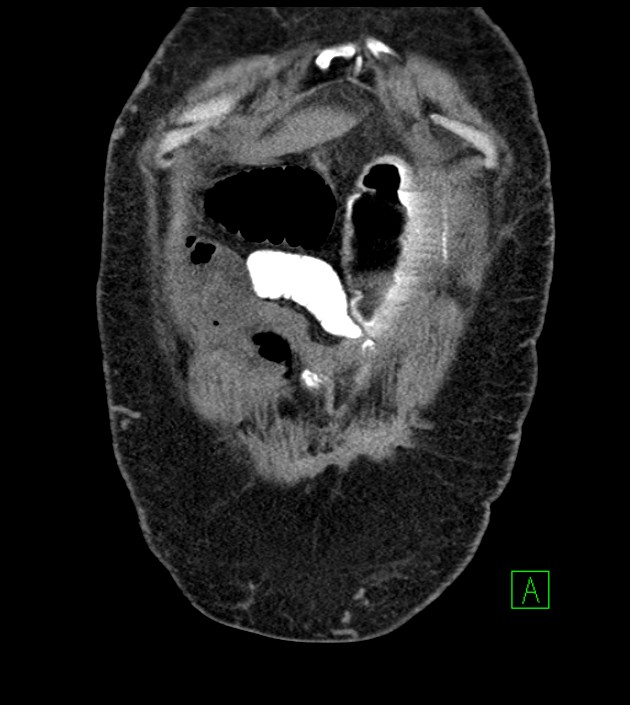 Closed-loop small bowel obstruction-internal hernia (Radiopaedia 78439-91096 Coronal non-contrast 20).jpg