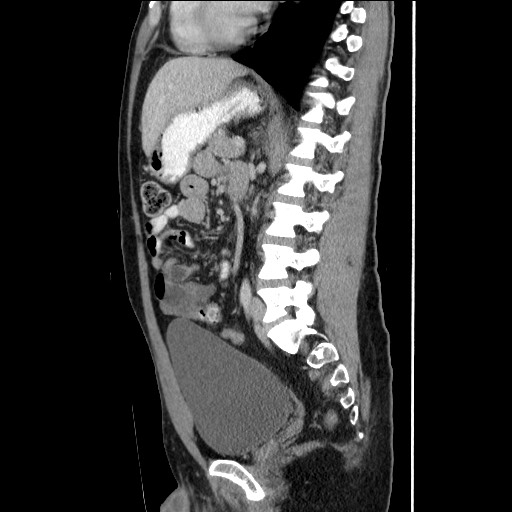 Closed-loop small bowel obstruction (Radiopaedia 73713-84509 B 97).jpg