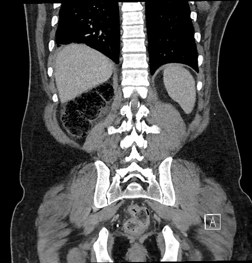 Closed loop obstruction - internal hernia into nephrectomy bed (Radiopaedia 59867-67320 B 110).jpg