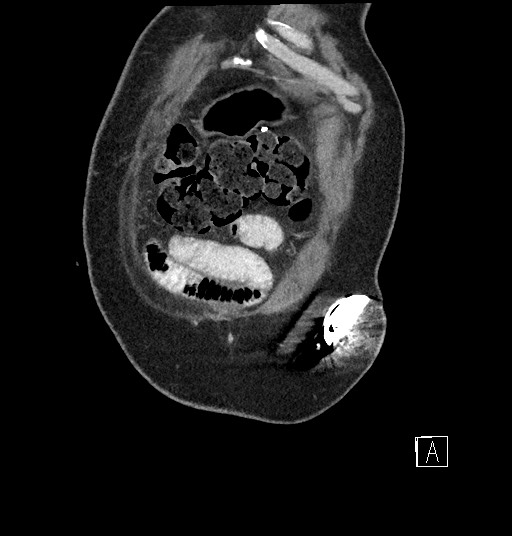 File:Closed loop obstruction - internal hernia into nephrectomy bed (Radiopaedia 59867-67320 B 3).jpg