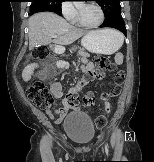 Closed loop obstruction - internal hernia into nephrectomy bed (Radiopaedia 59867-67320 B 51).jpg