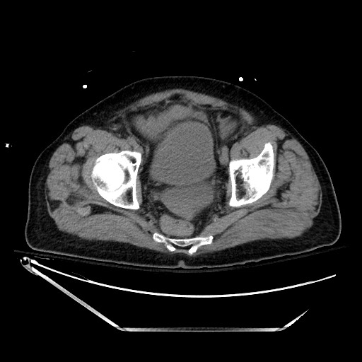 File:Closed loop obstruction due to adhesive band, resulting in small bowel ischemia and resection (Radiopaedia 83835-99023 Axial non-contrast 138).jpg