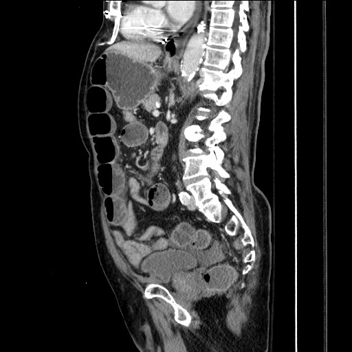 File:Closed loop obstruction due to adhesive band, resulting in small bowel ischemia and resection (Radiopaedia 83835-99023 F 106).jpg