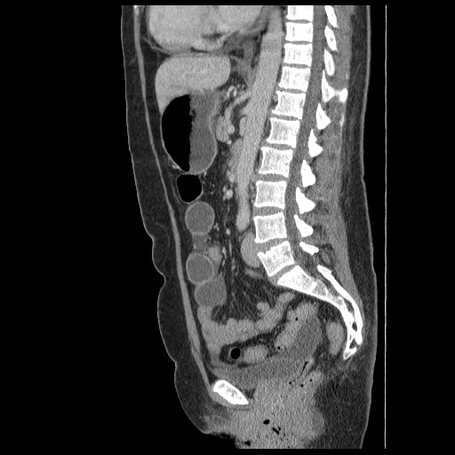 Closed loop small bowel obstruction (Radiopaedia 65403-74451 C 53).jpg