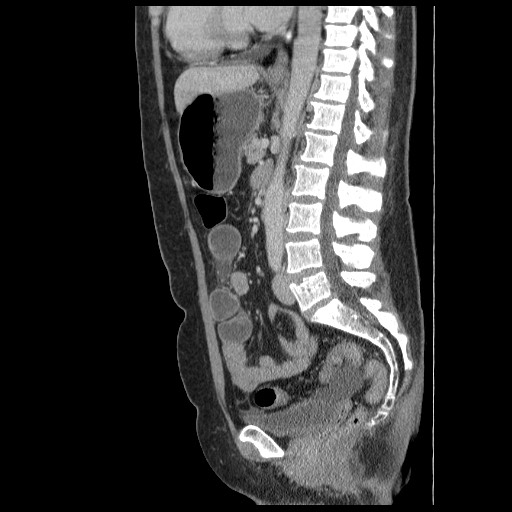 Closed loop small bowel obstruction (Radiopaedia 65403-74451 C 56).jpg