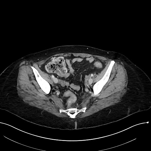 File:Closed loop small bowel obstruction - adhesions (Radiopaedia 59078-66369 Axial 62).jpg