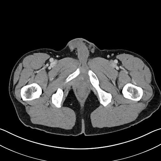 Closed loop small bowel obstruction - internal hernia (Radiopaedia 57806-64778 B 137).jpg