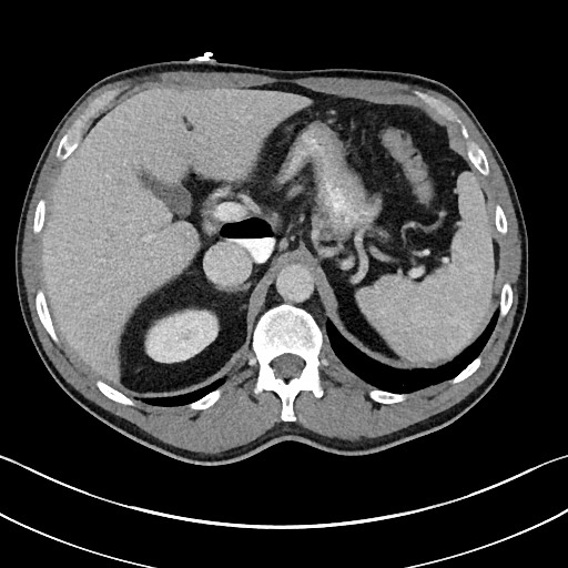 Closed loop small bowel obstruction - internal hernia (Radiopaedia 57806-64778 B 32).jpg