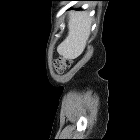 Closed loop small bowel obstruction due to adhesive band - U-shaped loop (Radiopaedia 83829-99012 C 64).jpg