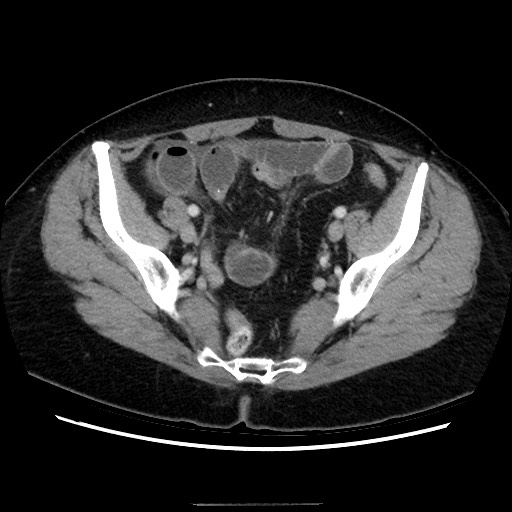 Closed loop small bowel obstruction due to adhesive bands - early and late images (Radiopaedia 83830-99015 A 134).jpg