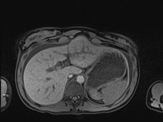 Closed loop small bowel obstruction in pregnancy (MRI) (Radiopaedia 87637-104031 Axial T1 fat sat 27).jpg