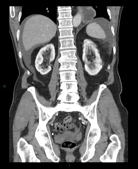 Closed loop small bowel obstruction with ischemia (Radiopaedia 84180-99456 B 20).jpg