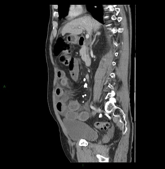 Closed loop small bowel obstruction with ischemia (Radiopaedia 84180-99456 C 39).jpg