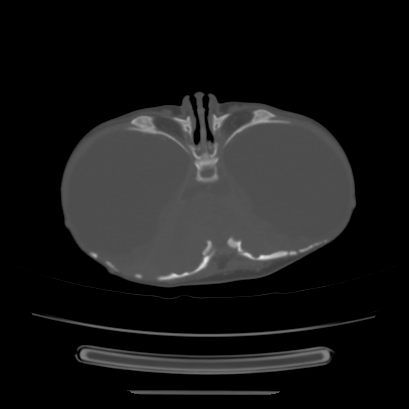 Cloverleaf skull (Radiopaedia 91901-109710 Axial bone window 59).jpg