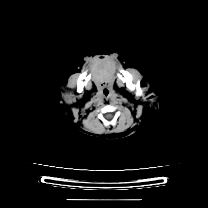 Cloverleaf skull (Radiopaedia 91901-109710 Axial non-contrast 32).jpg