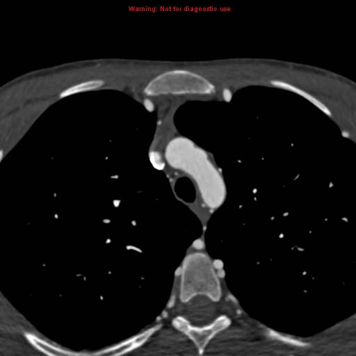 File:Coarctation of the aorta (Radiopaedia 12461-12697 A 39).jpg