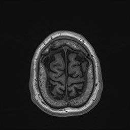 File:Cochlear incomplete partition type III associated with hypothalamic hamartoma (Radiopaedia 88756-105498 Axial T1 174).jpg