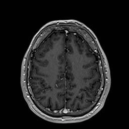 Cochlear incomplete partition type III associated with hypothalamic hamartoma (Radiopaedia 88756-105498 Axial T1 C+ 144).jpg