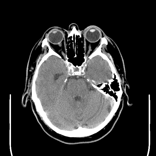 File:Colloid cyst (large) (Radiopaedia 34415-35734 Axial non-contrast 20).png