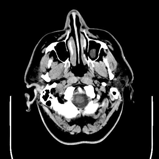 File:Colloid cyst (large) (Radiopaedia 34415-35734 Axial non-contrast 8).png