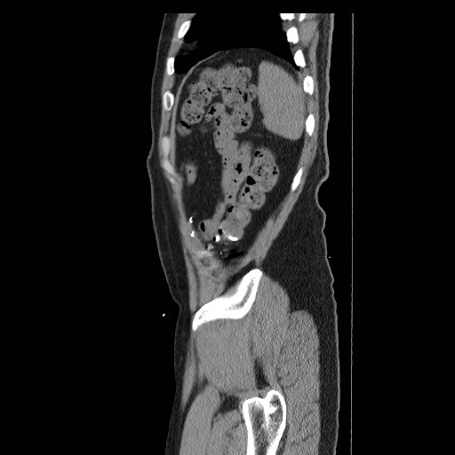 Colocutaneous fistula in Crohn's disease (Radiopaedia 29586-30093 F 50).jpg