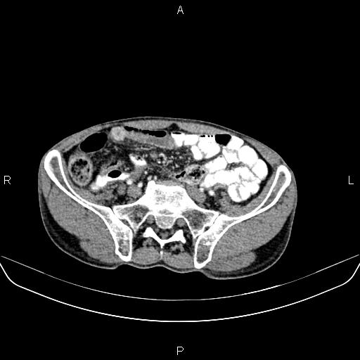 File:Colon adenocarcinoma - hepatic flexure (Radiopaedia 85635-101395 A 69).jpg